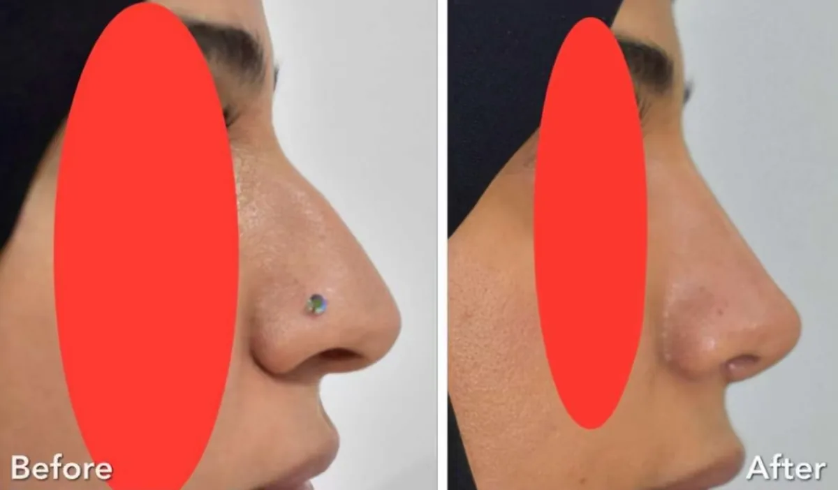تجميل الأنف — نتيجة قبل وبعد