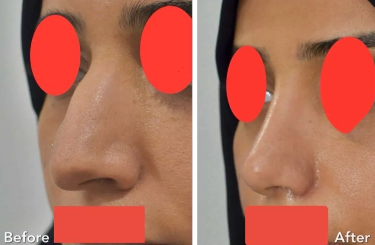 تجميل الأنف — نتيجة قبل وبعد